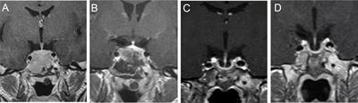 Hydroxychloroquine overcomes cabergoline resistance in a patient with Lactotroph Pituitary neuroendocrine tumor: a case report